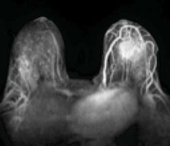 Image: MRI Image Displaying Invasive Breast Cancer (Photo courtesy of Cancer Network).