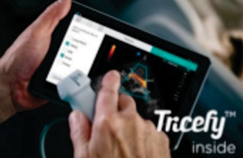 Image: iViz Point-of-Care Mobile Ultrasound Device with Tricefy Technology (Photo Courtesy of Fujifilm SonoSite and Trice Imaging).