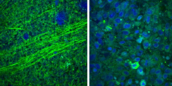 Image: Normal brain containing axons (left) under SRS microscopy, compared to disordered brain tumor tissue (right) (Photo courtesy of U-M).