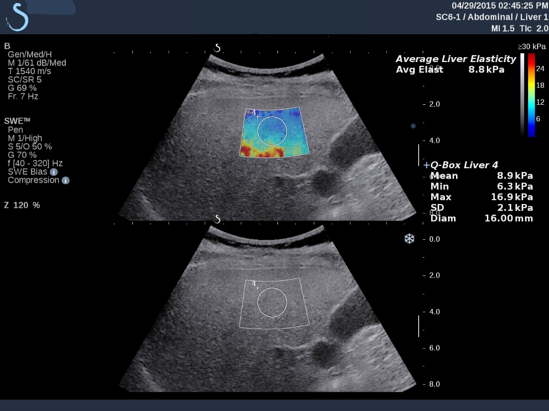 Image: A patient demonstrates a F2/F3 Fibrosis of the Liver with ShearWave Elastography after treatment (Photo courtesy of Dr. James Trotter, Baylor University Medical Center of Dallas).