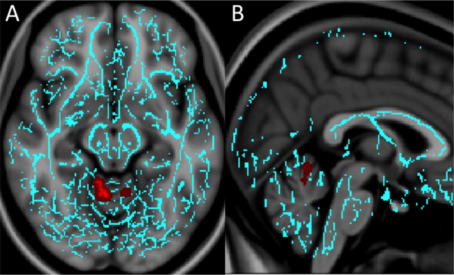 Image: Significant white matter differences in patients with mTBI and anxiety (Photo courtesy of RSNA).