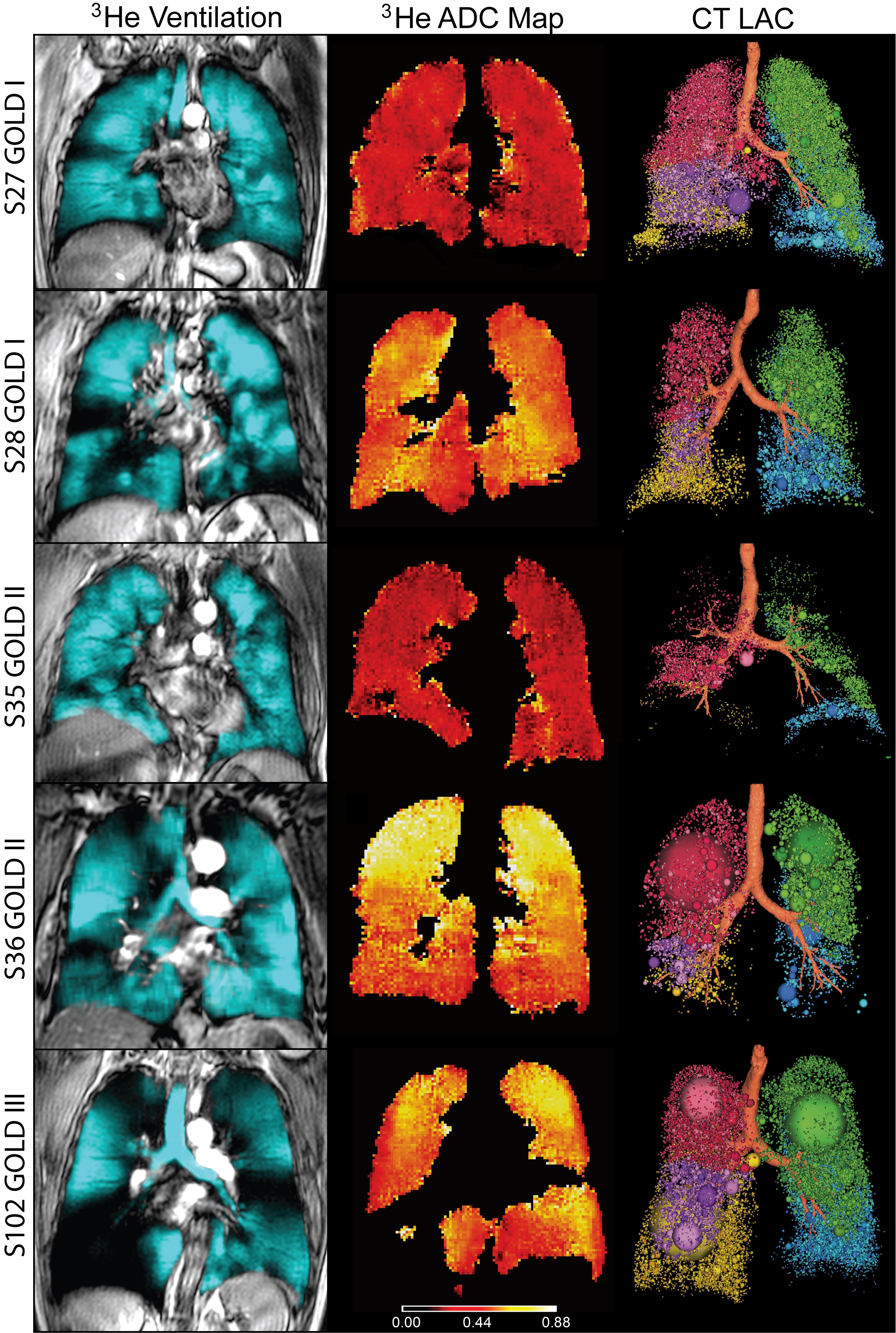 Image: Representative patients with mild-to-moderate or severe COPD (Photo courtesy of RSNA).