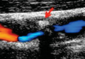 Image: Preoperative carotid ultrasound evaluation (Photo courtesy of Umea University).