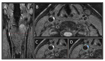 Image: (A) The 3-D MRI Intra-Plaque Hemorrhage (IPH) sequence acquired in the coronal plane; (B) the reformatted axial plane; (C) the section of the right carotid artery; (D) contours drawn for the outer wall, and lumen, and the IPH area shaded blue (Photo courtesy of RSNA).