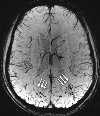 Image: The susceptibility-weighted image shows extensive micro-hemorrhage (see arrows) consistent with diffuse axonal injury in a 25-year-old man with blast-related mild TBI (Photo courtesy of RSNA).