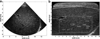 Image: Original B-Mode image next to back scan-converted B-mode image with interactively drawn fat layer contour (white dotted line); initial fixed region of interest (white rectangle); automatic segmentation within region of interest (white ellipses) (Photo courtesy of Ultrasound in Medicine & Biology).