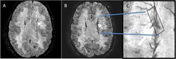 Image: MRI of the brain before (A) and after (B) ferumoxytol injection. A magnified image (C) demonstrates ferumoxytol accumulation (Photo courtesy of the University of Hawaii).