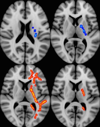 Image: MRI-DTI scans of the brains of US military veterans with MTBI (Photo courtesy of RSNA).