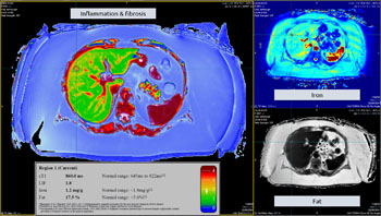 Image: The LiverMultiScan MRI technology for diagnosing NAFLD (Photo courtesy of Perspectum Diagnostics).