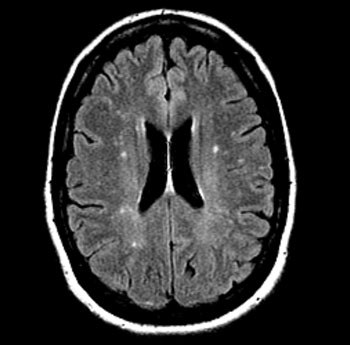 Image: Increased white matter in migraine headache (Photo courtesy of Medscape).