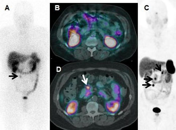 Image: The images demonstrate that Ga-68 DOTATATE PET/CT anterior 3D MIP and axial fused images could visualize metastases and change the surgical plan for resection (Photo courtesy of Ronald C. Walker, MD / Journal of Nuclear Medicine).
