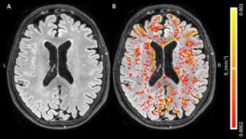 Image: The blood-brain barrier leakage maps of an 80-yeal old healthy control subject (Photo courtesy of RSNA).
