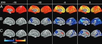 Image: Differences between carriers and noncarriers in PiB (A), FDG (B), and cortical thickness (C) at −15, −10, −5, and 0 years before predicted symptom onset (Photo courtesy of PNAS).
