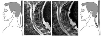 Image: (L) An MRI image showing the result of moving a coil array a small distance away from a patient, and (R) an image showing results of using one of the new coils wrapped tightly around the patient (Photo courtesy of University of California, Berkeley).