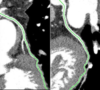 Image: CT scan of coronary artery centerlines. The PROMISE trial showed CT is as effective as stress tests and SPECT to assess chest pain (Photo courtesy of Duke University).