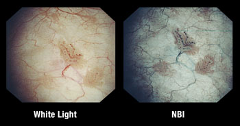 Image: A comparison of white light to narrow band imaging (Photo courtesy of Olympus Medical Systems).