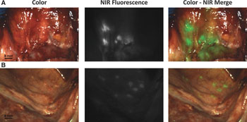 Image: An intraoperative detection of ovarian cancer metastases using fluorescence-based imaging (Photo courtesy of LUMC).