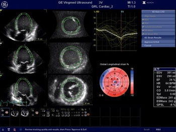 Image: Researchers found using strain echocardiography could accurately predict which patients were likely to have complications from hypertrophic cardiomyopathy (Photo courtesy of GE / JHU).