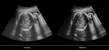 Image: A raw ultrasound image, and the same image enhanced using ContextVision GOP technology (Photo courtesy of ContextVision).