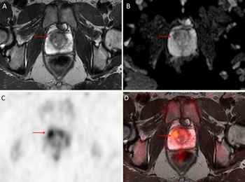 Image: The graphic shows Gleason 3+4 prostate cancer in T2-weighted (A) and diffusion-weighted (B) MRI images. Graphic (C) shows F-18-choline PET, and graphic (D) shows PET/MRI (D) (Photo courtesy of the University of Michigan).
