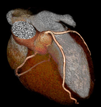 Image: Cardiac CT scans have revealed a link between higher inflammatory biomarkers and heart disease in male HIV Patients (Photo courtesy of the Multicenter AIDS Cohort Study).
