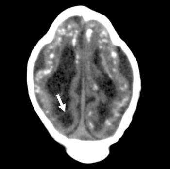 Image: The image displays an axial CT scan of a 1-month-old male with a presumed Zika virus infection, and shows ventriculomegaly with septation, calcifications, an abnormally diffused gyral pattern, and a deformed skull (Photo courtesy of RSNA).