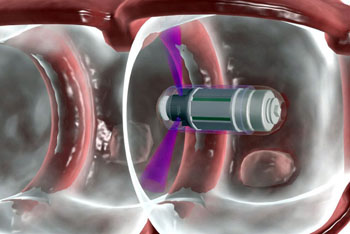 Image: The Check-Cap capsule system (Photo courtesy of Check-Cap).