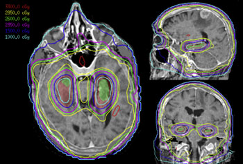 Image: The image displays an example of Hippocampal-sparing whole brain radiotherapy (Photo courtesy of ResearchGate).