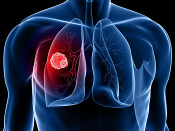 Image: An artist’s rendition showing lung cancer (Photo courtesy of Dreamstime).