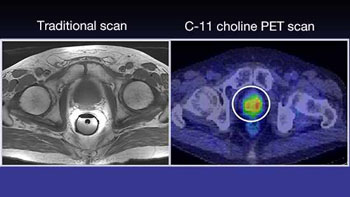 Image: A comparison of a traditional scan and a C-11 Choline Positron Emission Tomography (PET) imaging scan for the detection of prostate cancer recurrence sites (Photo courtesy of the Mayo Clinic).