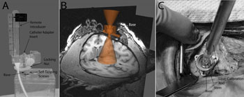 Image: The details of the technique used for MRI-guided transplantation of neural stem cells into the Parkinsonian brain (Photo courtesy of Vermilyea SC).