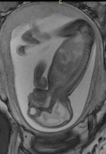 Image: A side view of a fetus with hands and clubfeet, enlarged cerebral fluid space, cerebral ventricles dilation, less brain tissue, absence of brain cortical gyri, and a poorly developed cerebellum (Photo courtesy of RSNA).