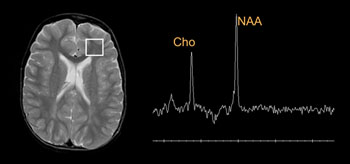 Image: A magnetic resonance spectroscopy (MRS) of a child’s brain (Photo courtesy of Cincinnati Children\'s Hospital).