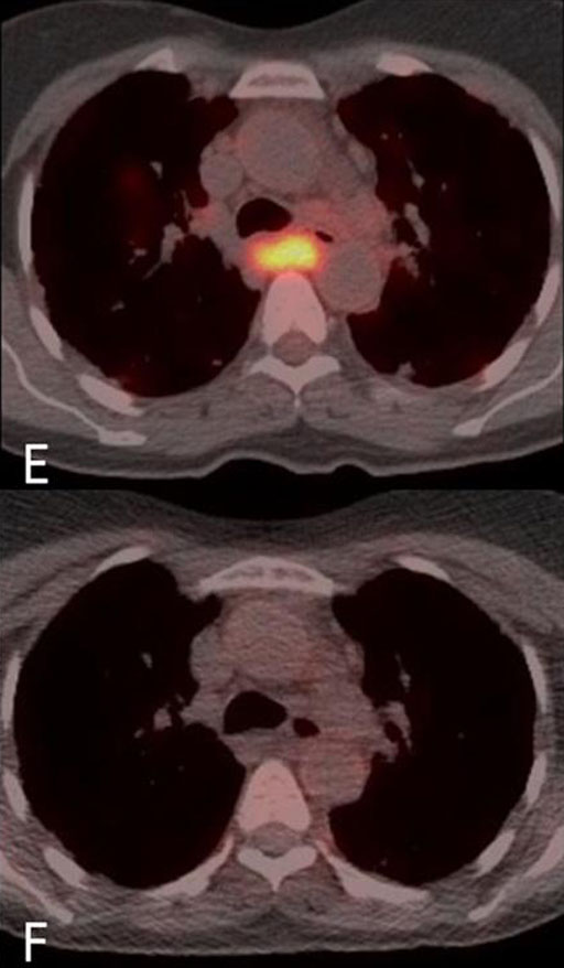 Image: FDG PET-CT chest imaging in a patient with GLILD - FDG uptake is represented by color intensity (Photo courtesy of S. Jolles, University Hospital of Wales).