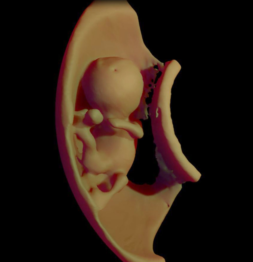Image: A 3D virtual model ultrasound view of fetus at 12 weeks (photo courtesy of Heron Werner/CDPI).
