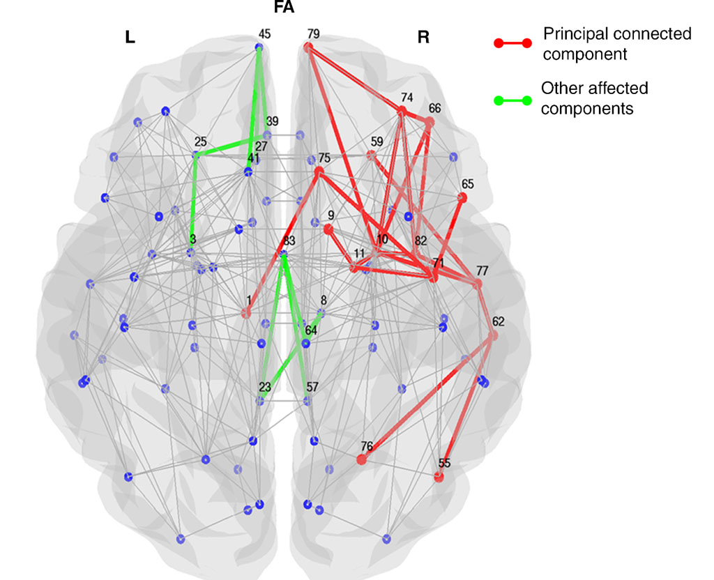 Image: The impaired structural sub-network connectivity in the brains of patients with Parkinson disease and MCI, and those without MCI (Photo courtesy of RSNA).
