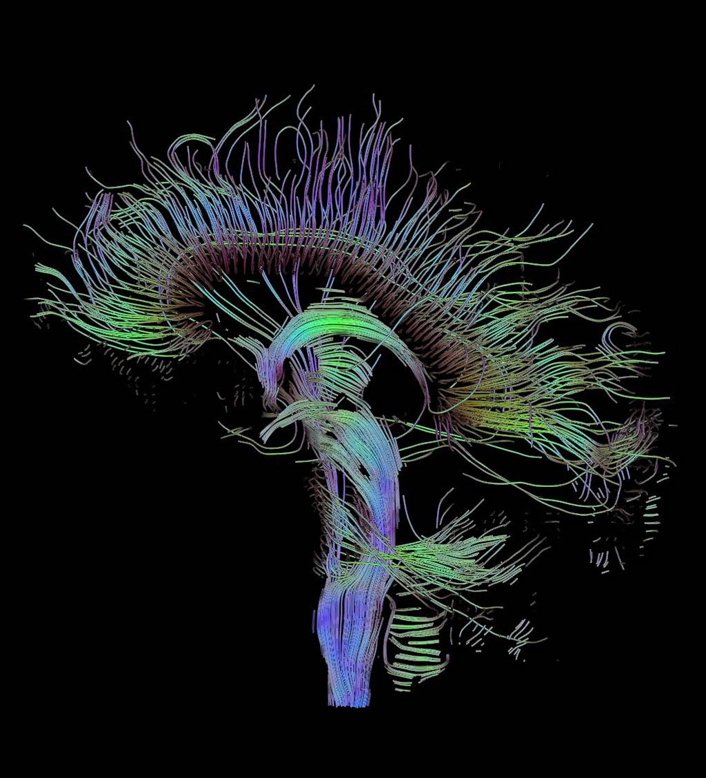 Image: An MRI-DTI visualization of the connections in a human brain (Photo courtesy of Thomas Schultz / Wikimedia Commons).