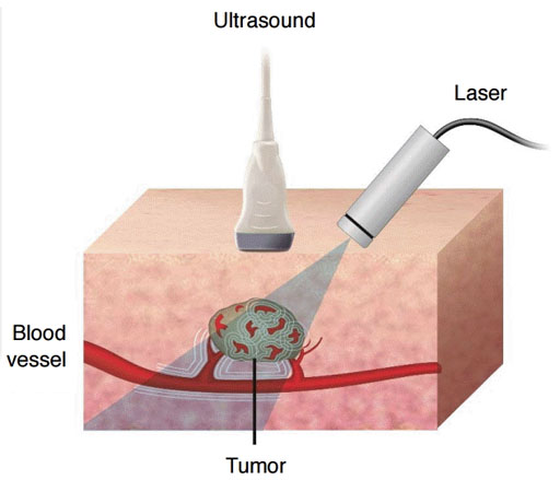 Image: The diagram describes the principle of the photoacoustic effect and imaging used in the SENO Medical Imagio modality (Photo courtesy of Ultrasonography).