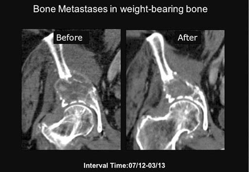 Image: One coronal CT image was taken before treatment, and the other eight months afterwards. The images demonstrate that the treatment resulted in de novo mineralization in target area, and partial restoration of cortical bone (Photo courtesy of RSNA).