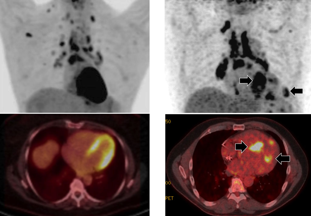 Image: The upper images shows PET scans, and the lower images combined PET/CT images of the heart. The images on the left show a patient on a 24-hour high-fat, low-sugar diet, while the right-hand images are those of a patient on a 72 hours high-fat, low sugar diet (Photo courtesy of UIC).