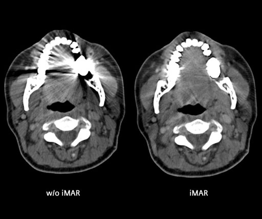 Image: An example of the application of iterative Metal Artifact Reduction (iMAR) in CT imaging (Photo courtesy of University Erlangen Radiologie, Erlangen, Germany).