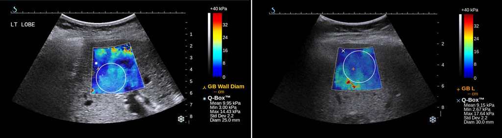 Image: An example of Shear Wave Elastography (SWE) images of the liver (Photo courtesy of MGH Department of Radiology).