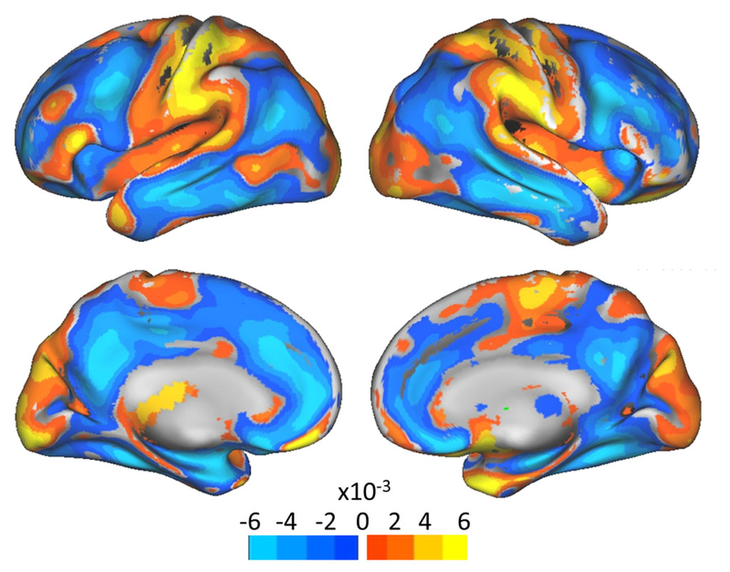 Image: Grey matter reduction in pregnant women (orange), compared to controls (Photo courtesy of UAB).
