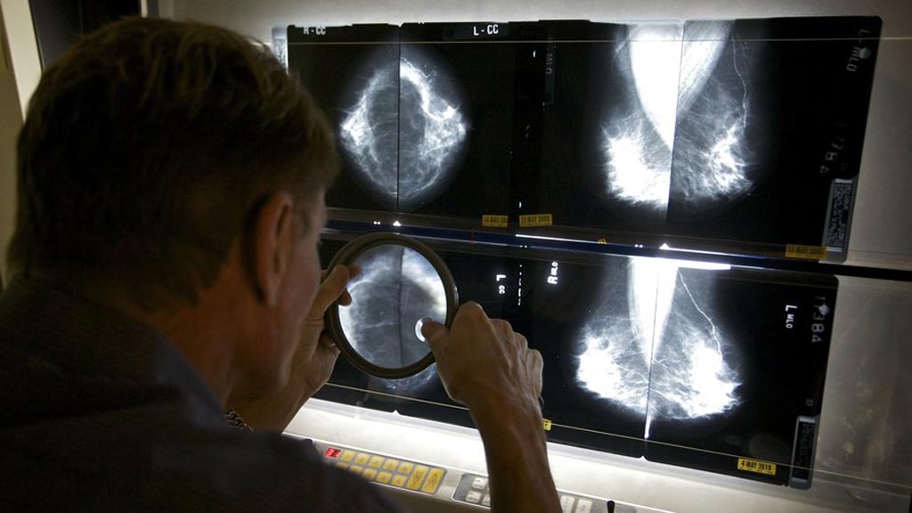 Image: While mammography screening is good at finding tumors, it cannot easily distinguish which ones are harmless from those that are dangerous (Photo courtesy of Damian Dovarganes/AP).