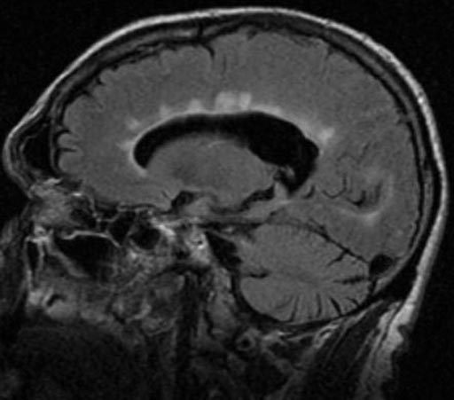 Image: An MRI image showing Dawson\'s fingers in the brain of a patient with multiple sclerosis (Photo courtesy of Radiopaedia).