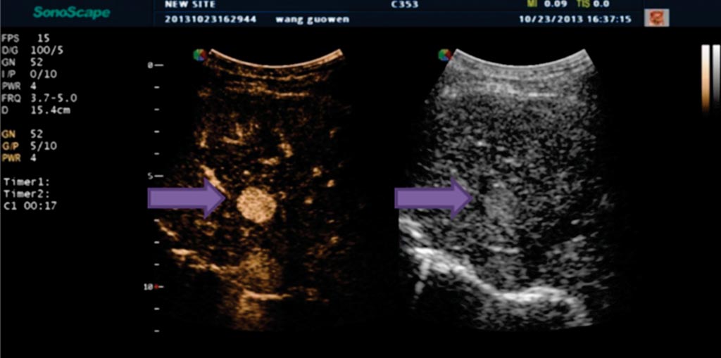 Image: Indeterminate liver lesion in patient with cirrhosis (arrow) demonstrating avid arterial phase hyper-enhancement, suspicious for HCC (Photo courtesy of Andrej Lyshchik, M.D., Ph.D., Thomas Jefferson University Hospital).