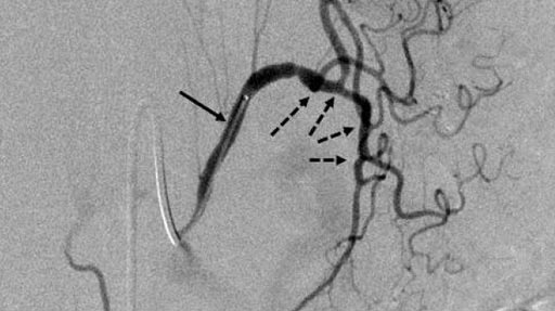 Image: A left gastric artery angiography (black arrow) showing fundus of stomach (dashed arrows) (Photo courtesy of RSNA).
