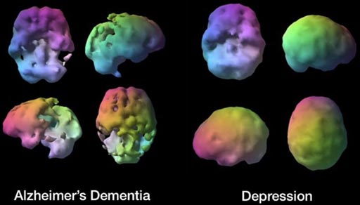 Image: Representative brain SPECT scans in Alzheimer\'s dementia and depression (Photo courtesy of Amen Clinics).