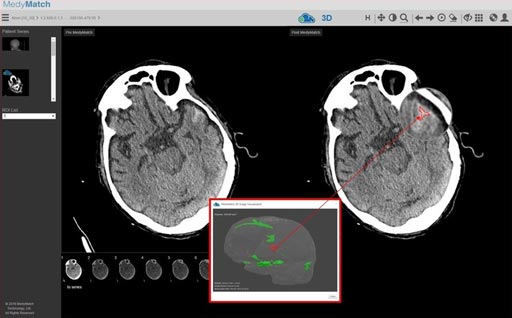 Image: The MedyMatch intracranial bleed detection application, including 3D rendering of the location and volume of bleeding (Photo courtesy of MedyMatch).