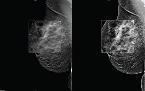 Image: A new study shows digital breast tomosynthesis reduces cancer surgery re-excision rates (Photo courtesy of Carestream Health).